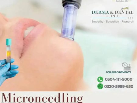 Advanced Facial Rejuvenation: Microneedling with PRP at Derma & Dental Clinic Lahore For Cheap