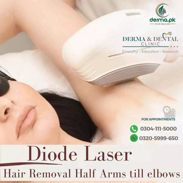 Hair Removal Laser Treatment in Pakistan Trusted by Dermatologist Online Hot Sale