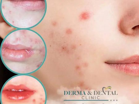 Unlock Flawless Skin: Your Guide to Acne Solutions at Derma & Dental Clinic on Sale