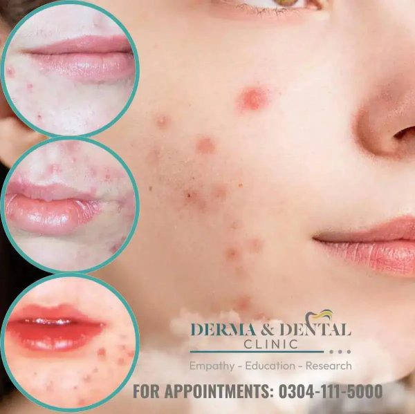 Unlock Flawless Skin: Your Guide to Acne Solutions at Derma & Dental Clinic on Sale