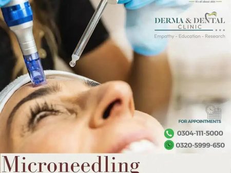 Microneedling for Stretch Marks at Derma & Dental Clinic For Sale