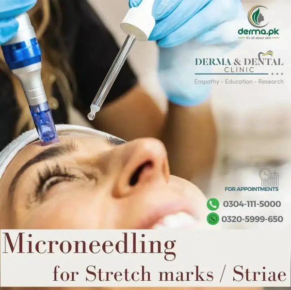 Microneedling for Stretch Marks at Derma & Dental Clinic For Sale