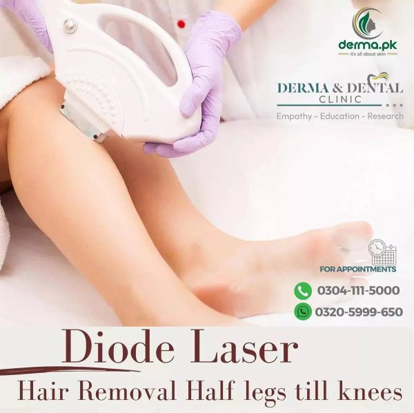 Precision Diode Laser Hair Removal: Half Legs till Knees - Derma & Dental Clinic Hot on Sale