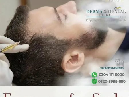 Advanced Scalp Rejuvenation: Exosome Therapy at Derma & Dental Clinic Online Hot Sale