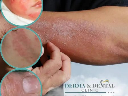 Conquer Atopic Eczema with Derma & Dental Clinic: Your Path to Healthy, Itch-Free Skin Fashion