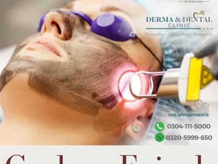 Celebrate Radiant Skin: Unveiling the Science of Carbon Facial with PECO Laser at Derma & Dental Clinic Supply