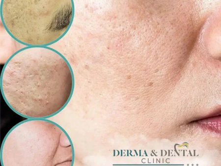 Erase Acne Scars and Unveil Your Radiant Skin: Derma & Dental Clinic s Expert Solutions For Sale