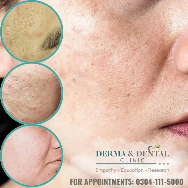 Erase Acne Scars and Unveil Your Radiant Skin: Derma & Dental Clinic s Expert Solutions For Sale