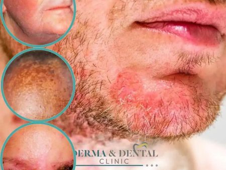 Expert Care for Seborrheic Eczema at Derma & Dental Clinic For Cheap