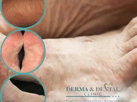 Suffering from Shoe Contact Eczema? Find Relief at Derma & Dental Clinic Bahria Town Lahore Online now