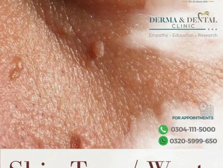 Advanced Dermatology Solutions: Expert Skin Tag and Wart Treatments Online now